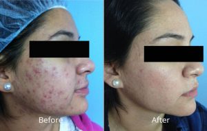 hydrafacial before after skin care institute tusla ok skin care institute - for radiant, healthy, younger-looking skin, call today to schedule your hydrafacial!
