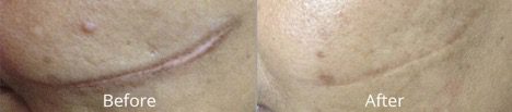 microneedling before & afters