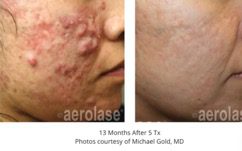 neoclear can fix your skin!